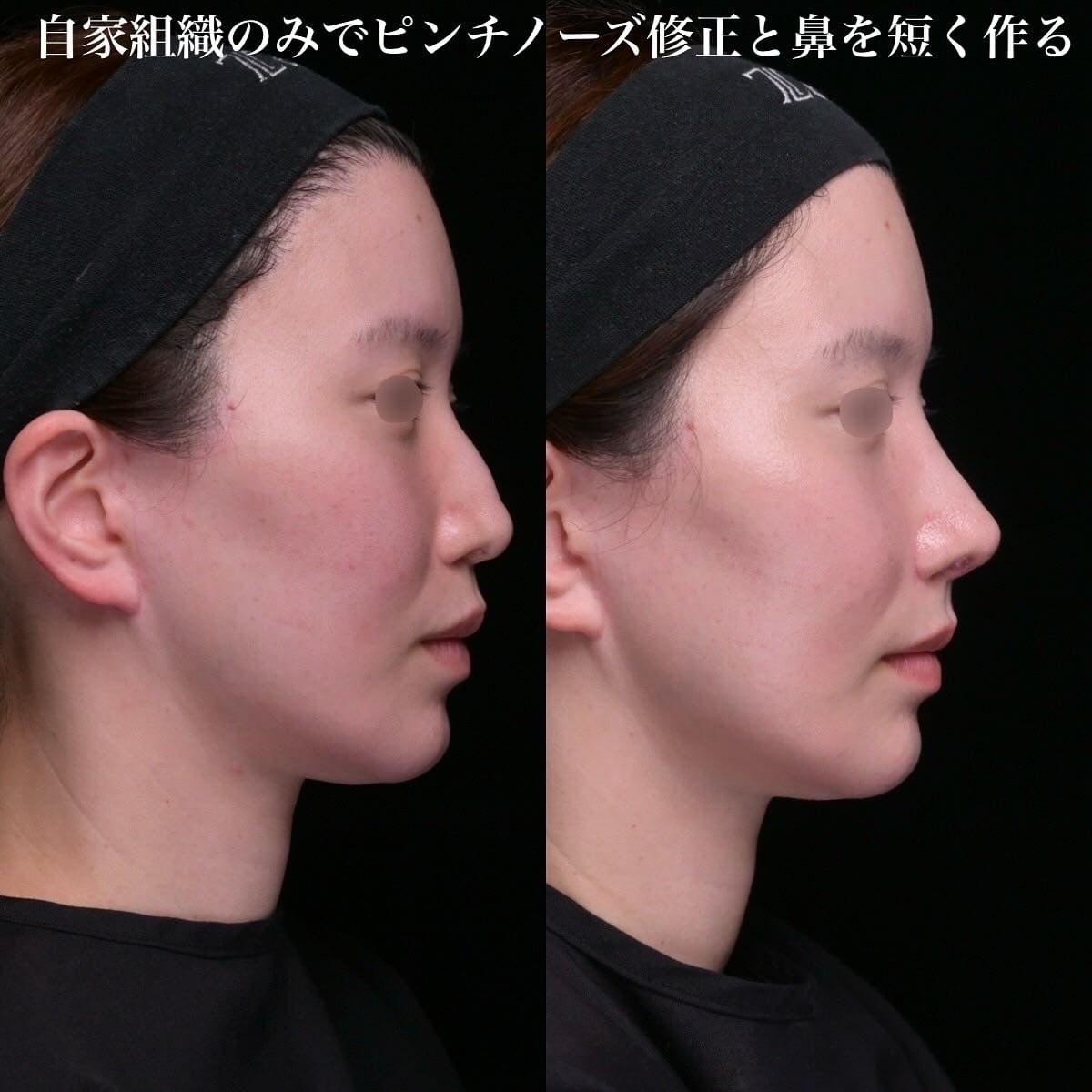 鉄　医師による鼻整形の術前/術後1ヶ月 术后 