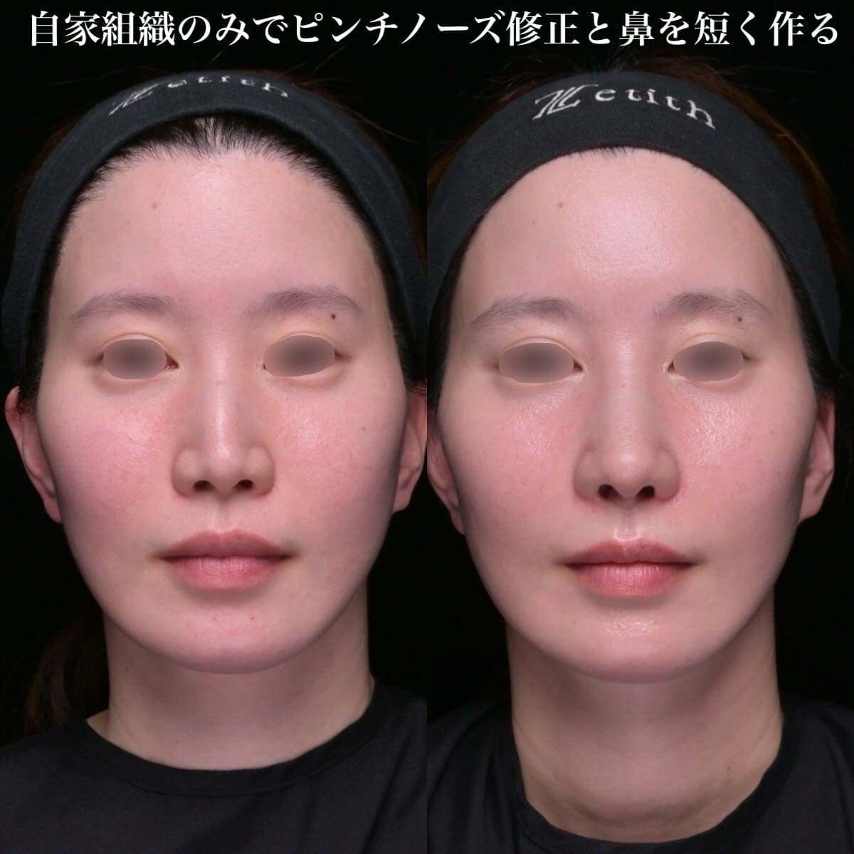 鉄　医師による鼻整形の術前/術後1ヶ月