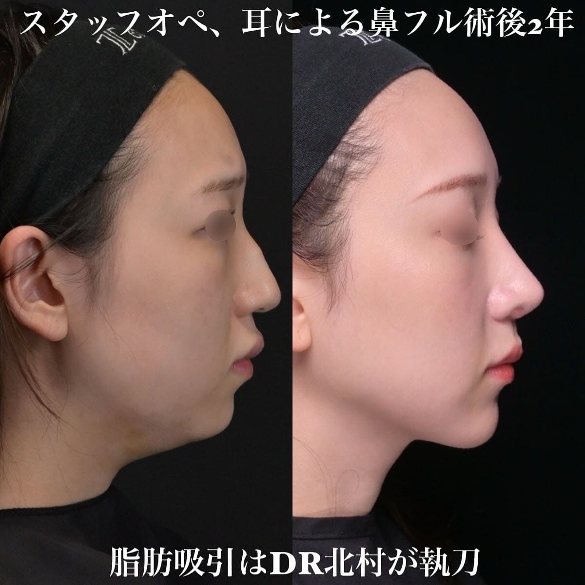 鉄医師による鼻整形の術前/術後2年 After 