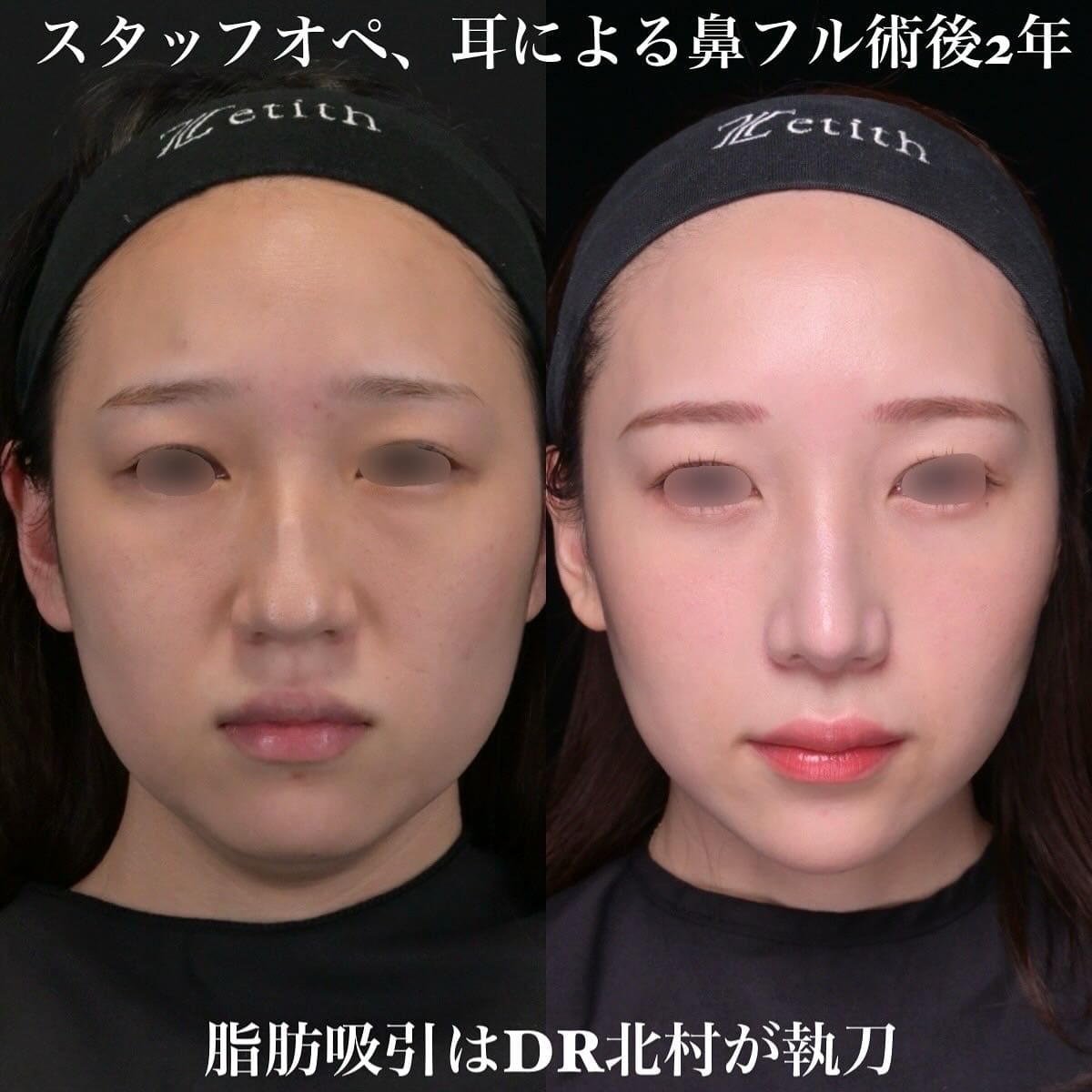 鉄医師による鼻整形の術前/術後2年