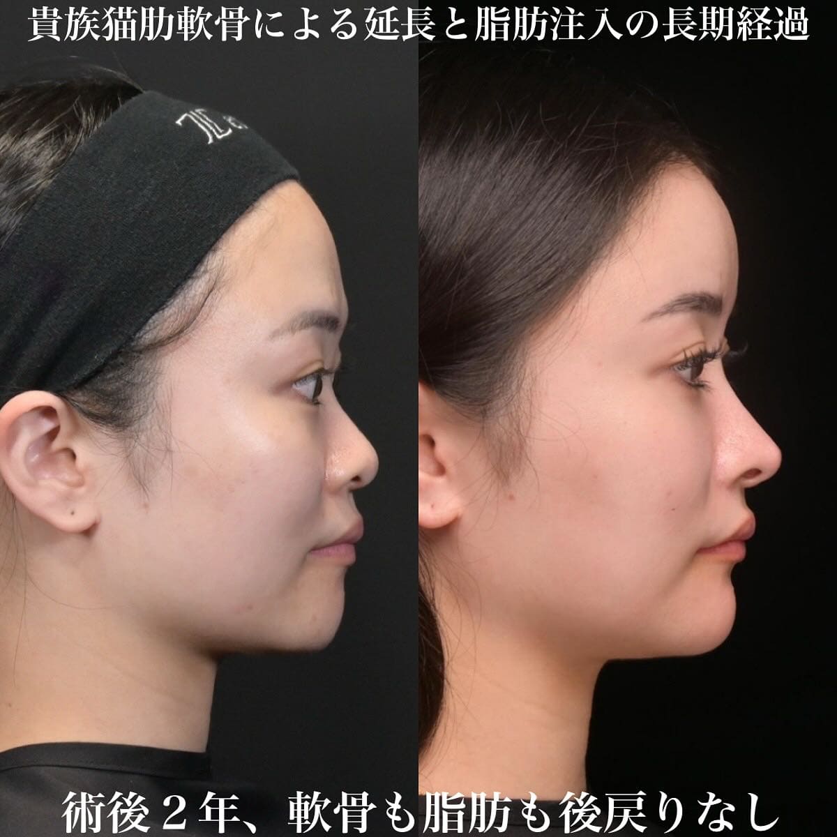 鉄医師による鼻整形の術前/術後2年 Sau 