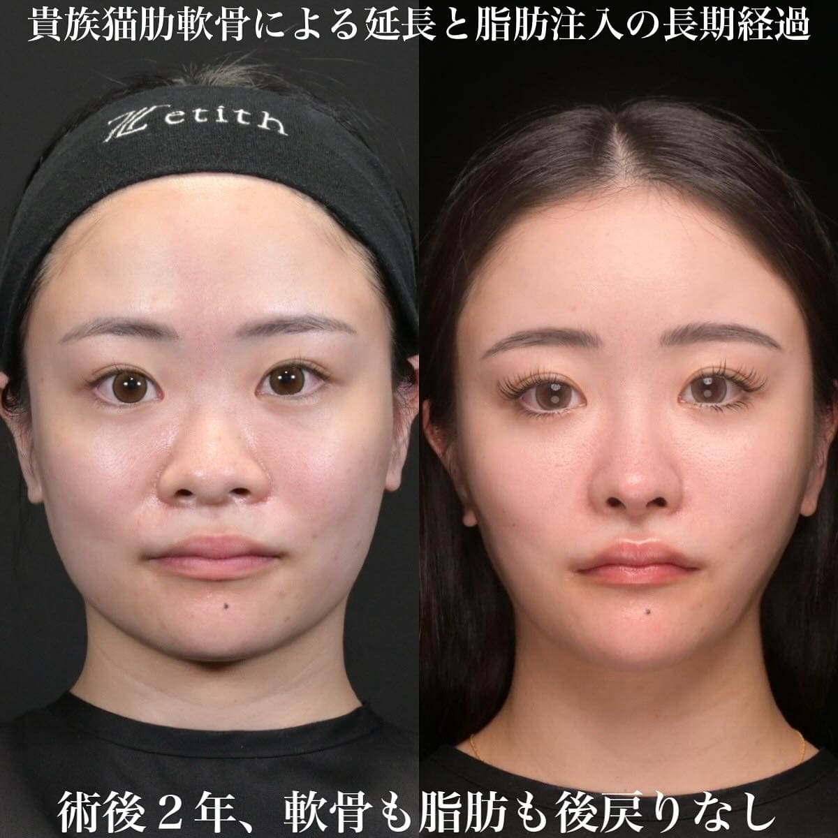 鉄医師による鼻整形の術前/術後2年