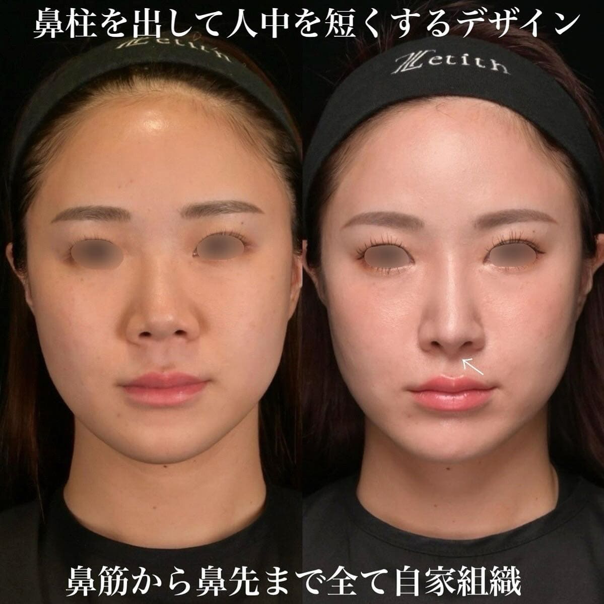 鉄医師による鼻整形の術前/術後6ヶ月