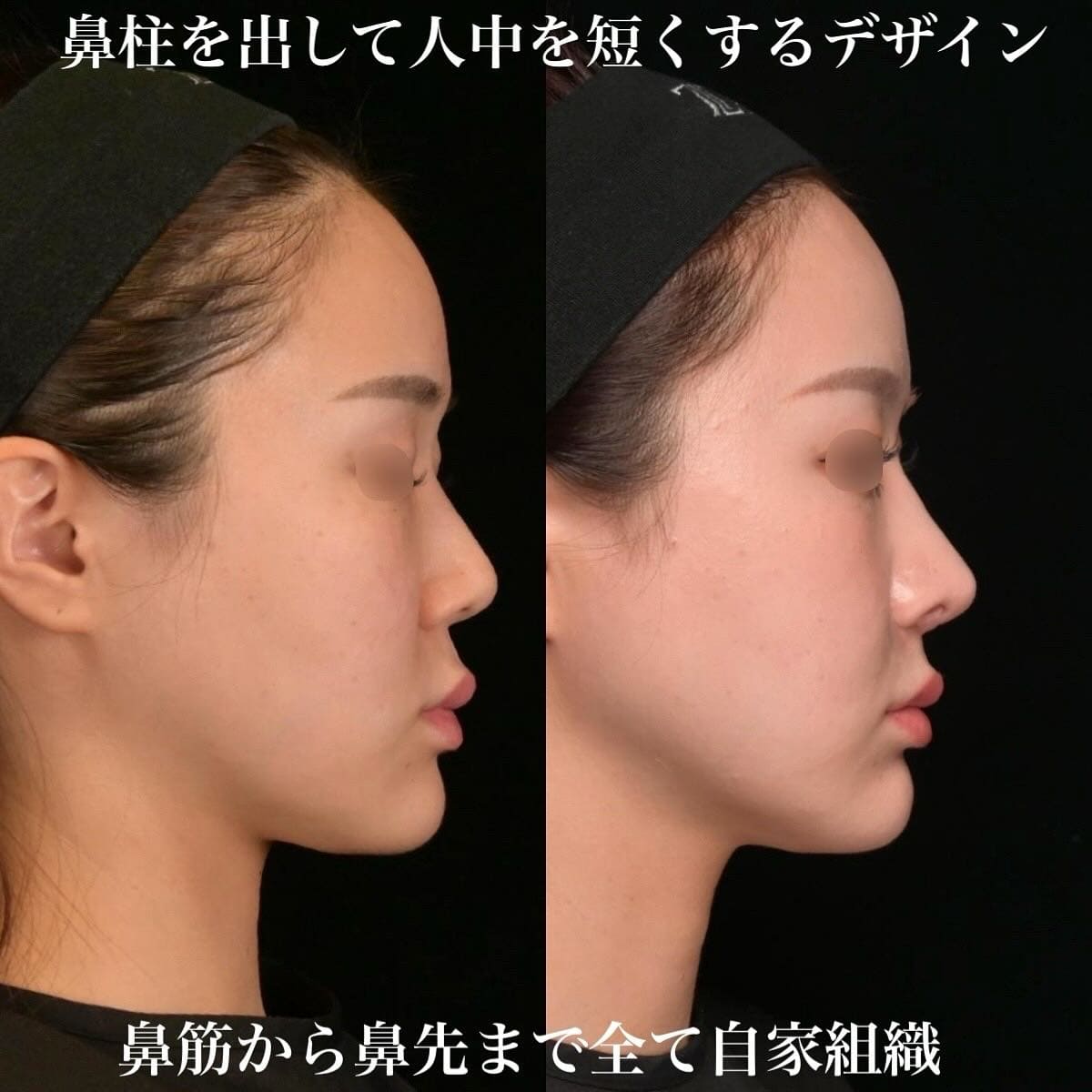 鉄医師による鼻整形の術前/術後6ヶ月 Sonra 