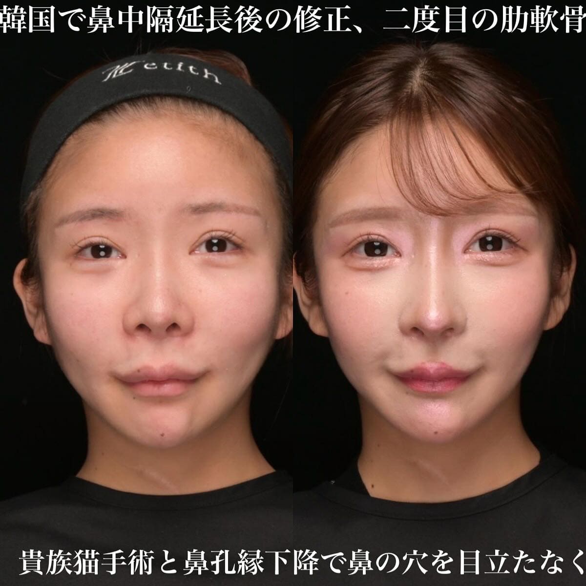 鉄医師による鼻整形の術前/術後３ヶ月