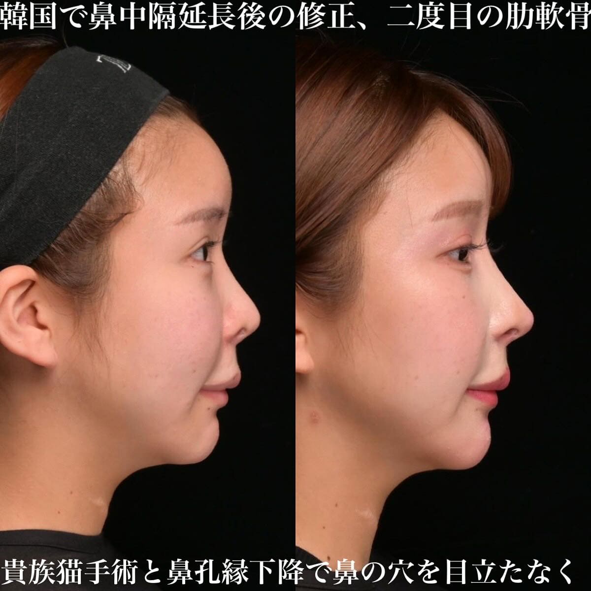 鉄医師による鼻整形の術前/術後３ヶ月 Дараа 