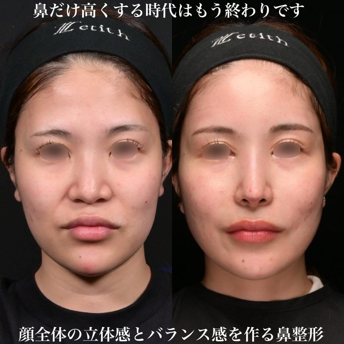 鉄医師による鼻整形の術前/術後３ヶ月