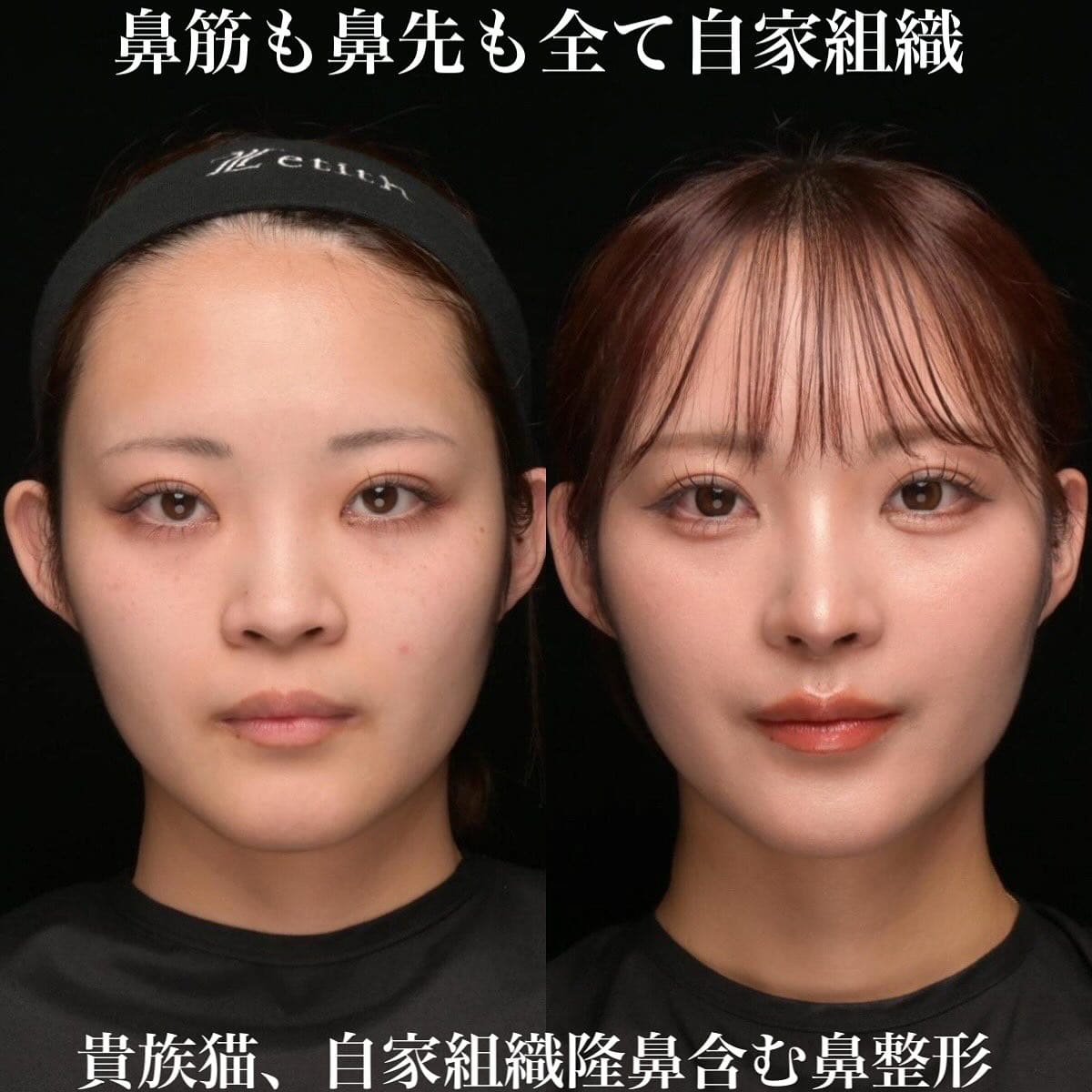鉄医師による鼻整形の術前/術後３ヶ月