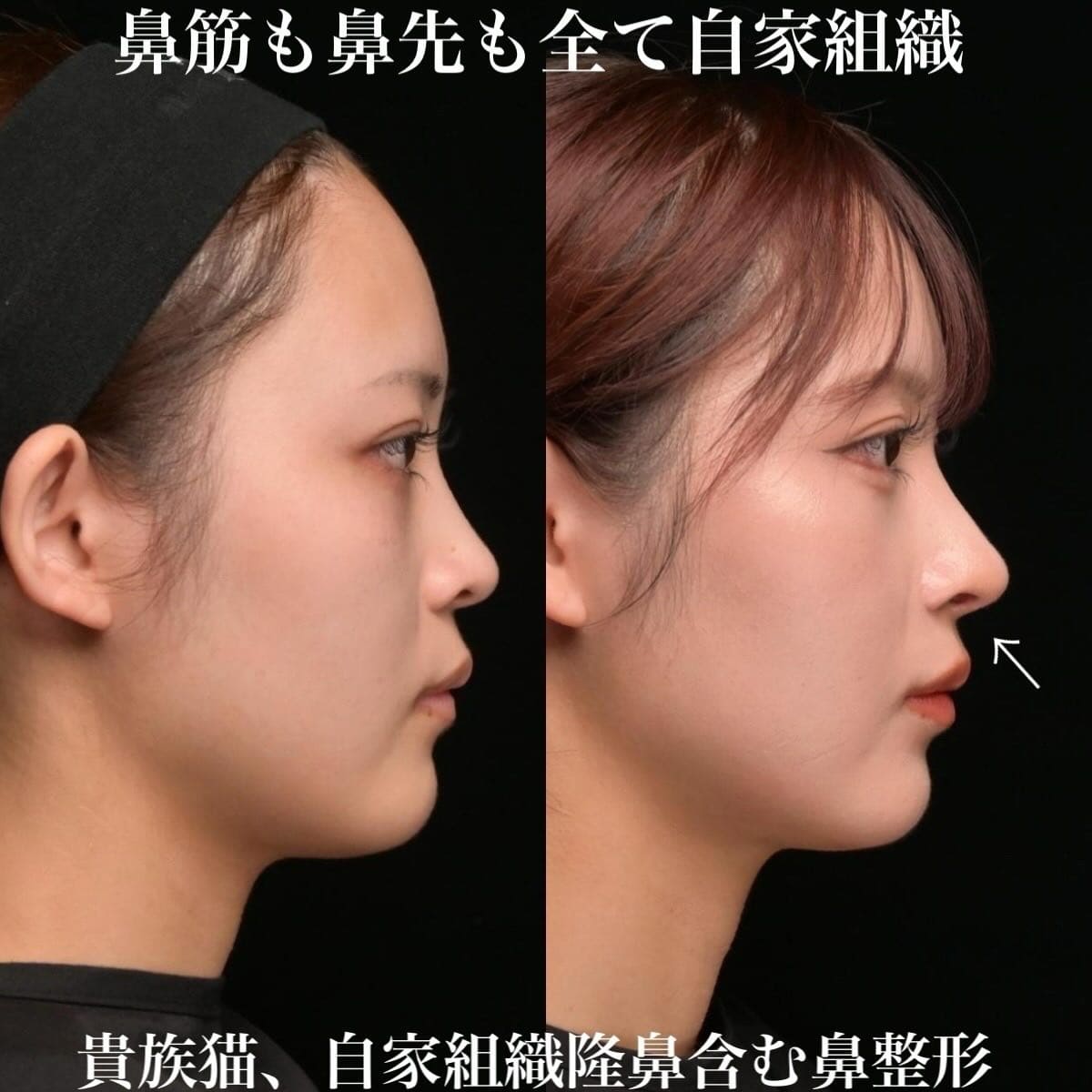 鉄医師による鼻整形の術前/術後３ヶ月 术后 