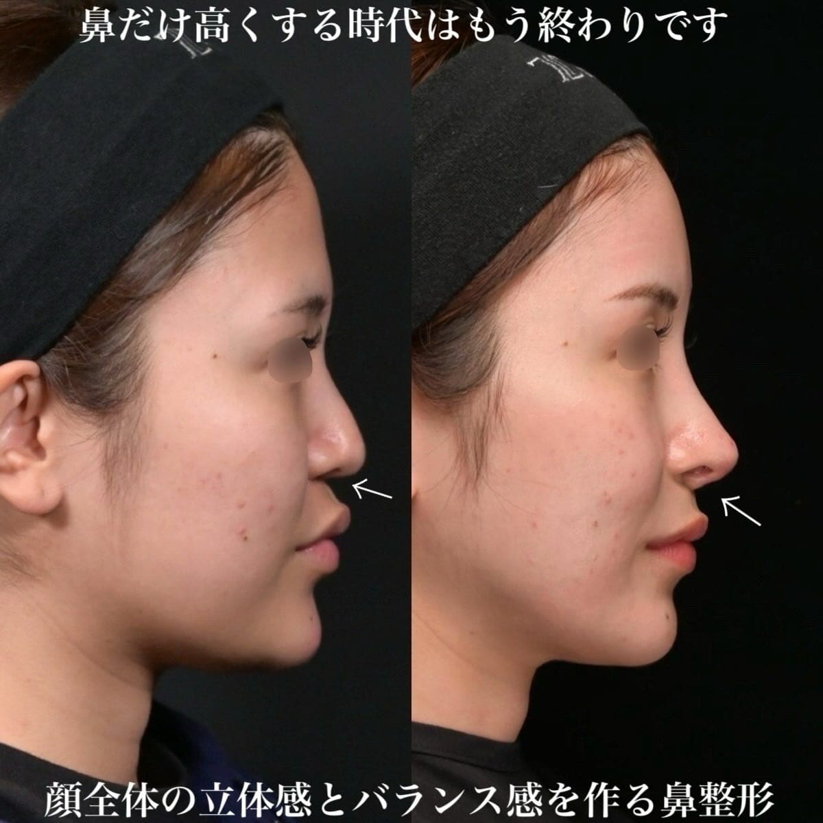鉄医師による鼻整形の術前/術後３ヶ月 Sau 
