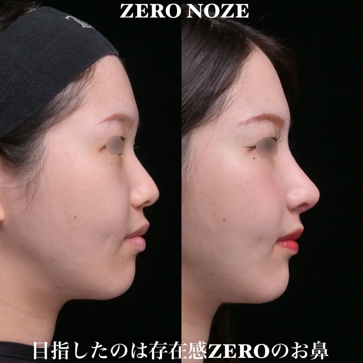 鉄医師による鼻整形の術前/術後1ヶ月 施術後 