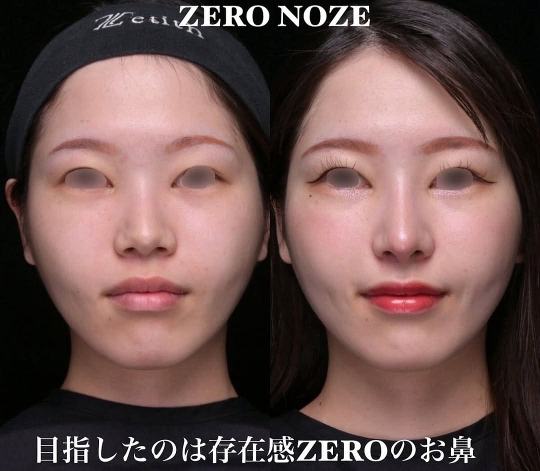 鉄医師による鼻整形の術前/術後1ヶ月