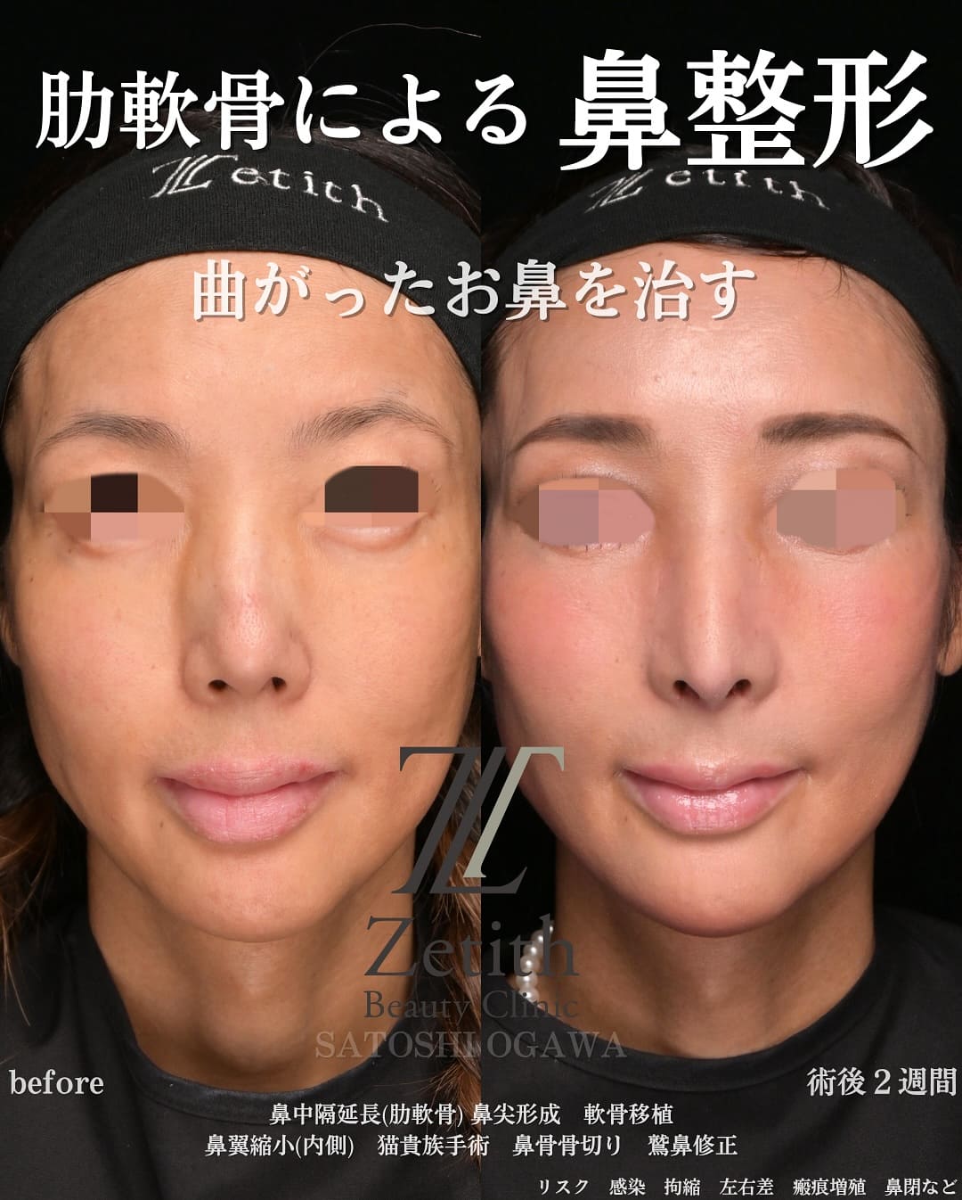 小川医師による鼻整形の術前/術後２週間