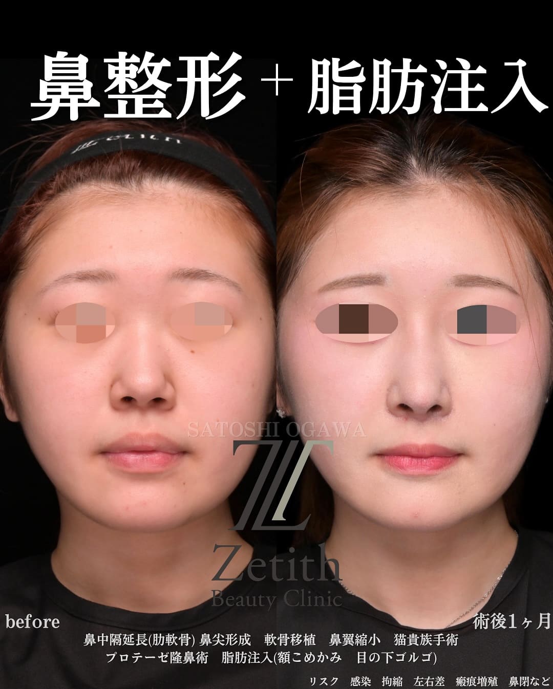 小川医師による鼻整形の術前/術後ヶ月