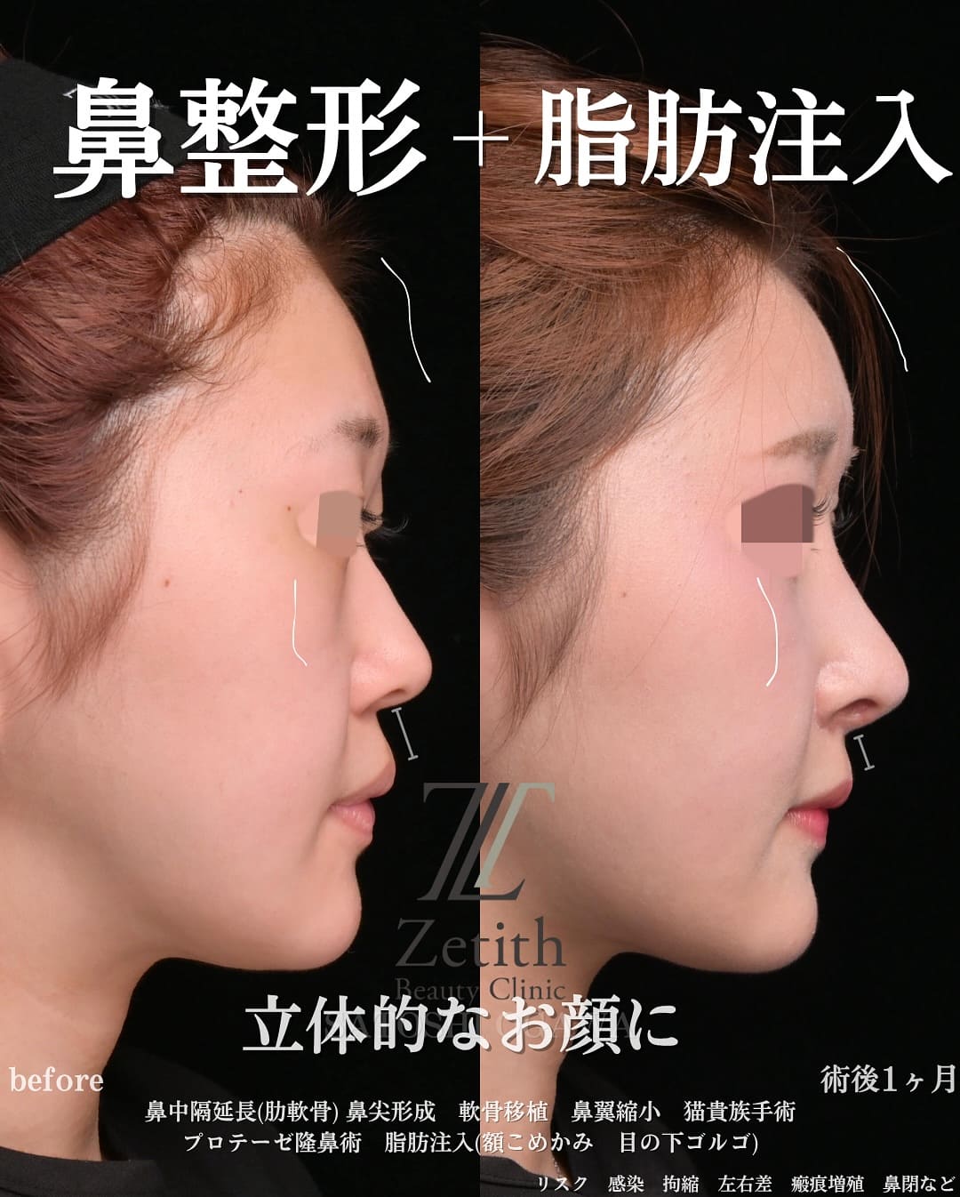 小川医師による鼻整形の術前/術後ヶ月 After 