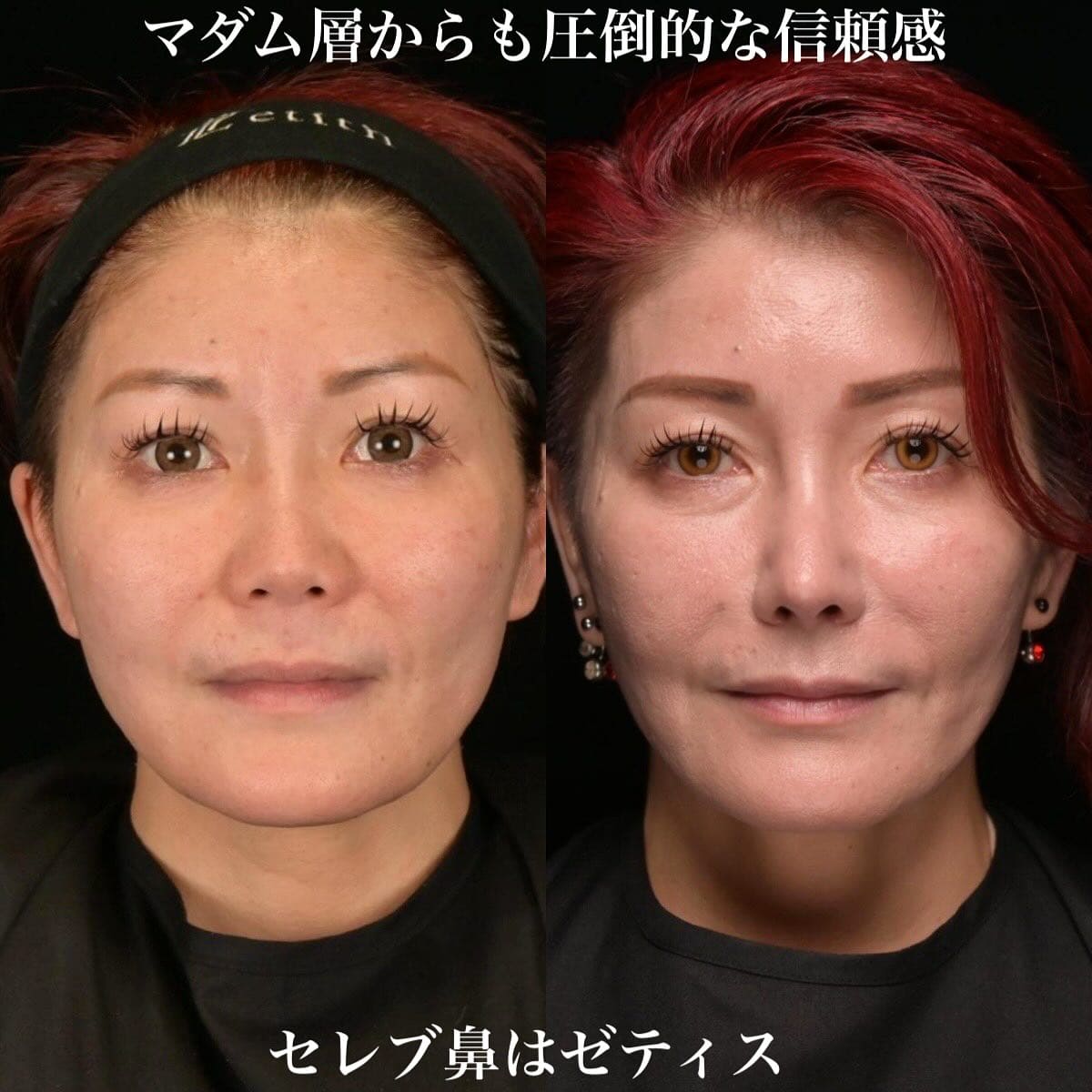 鉄医師による鼻整形の術前/術後6ヶ月