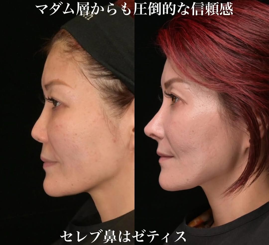 鉄医師による鼻整形の術前/術後6ヶ月 หลัง 