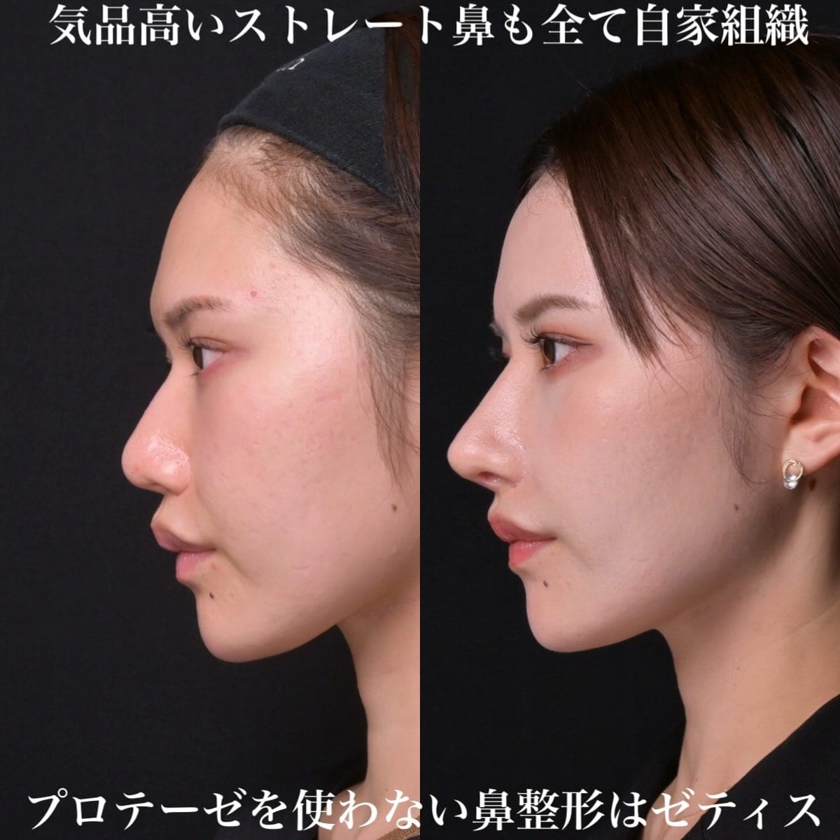 鉄医師による鼻整形の術前/術後1ヶ月 After 