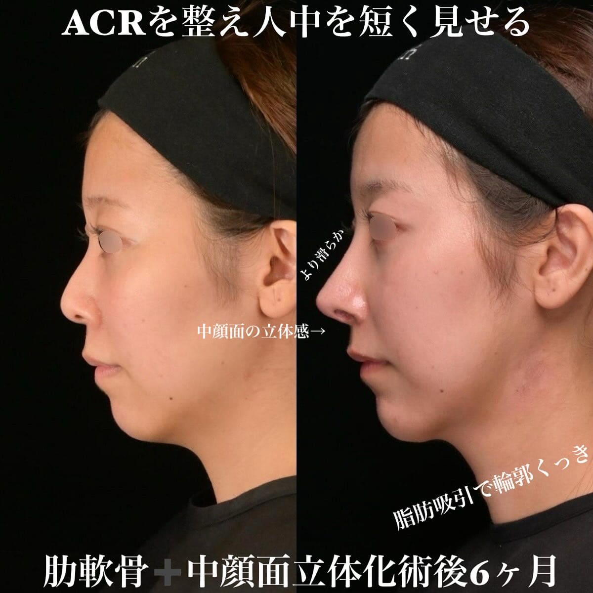 鉄医師による鼻整形の術前/術後6ヶ月 施術後 