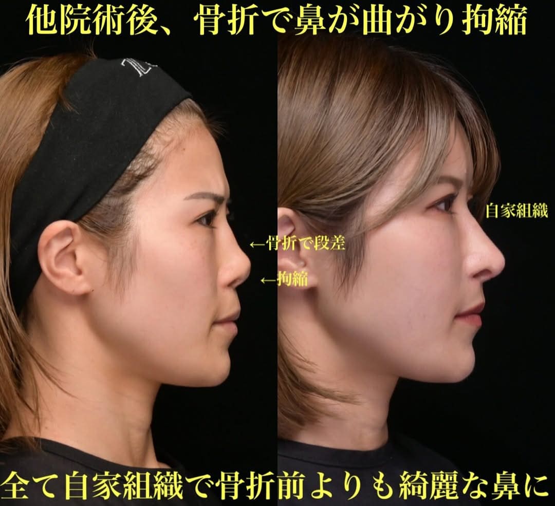 鉄医師による鼻整形の術前/術後３ヶ月 หลัง 