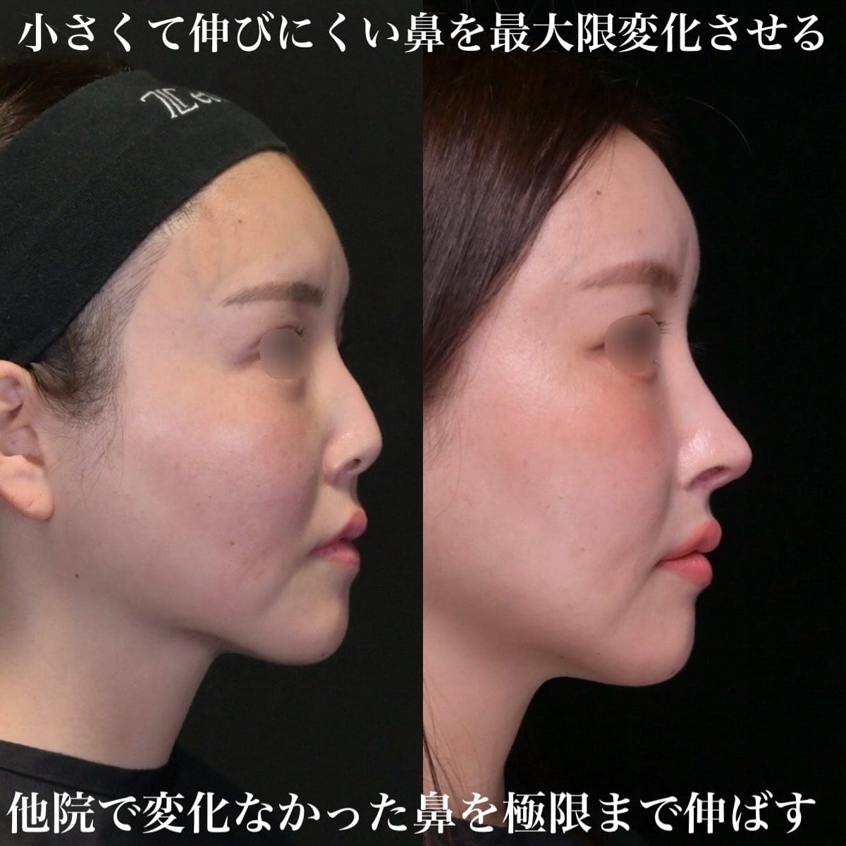 鉄医師による鼻整形の術前/術後1年 术后 