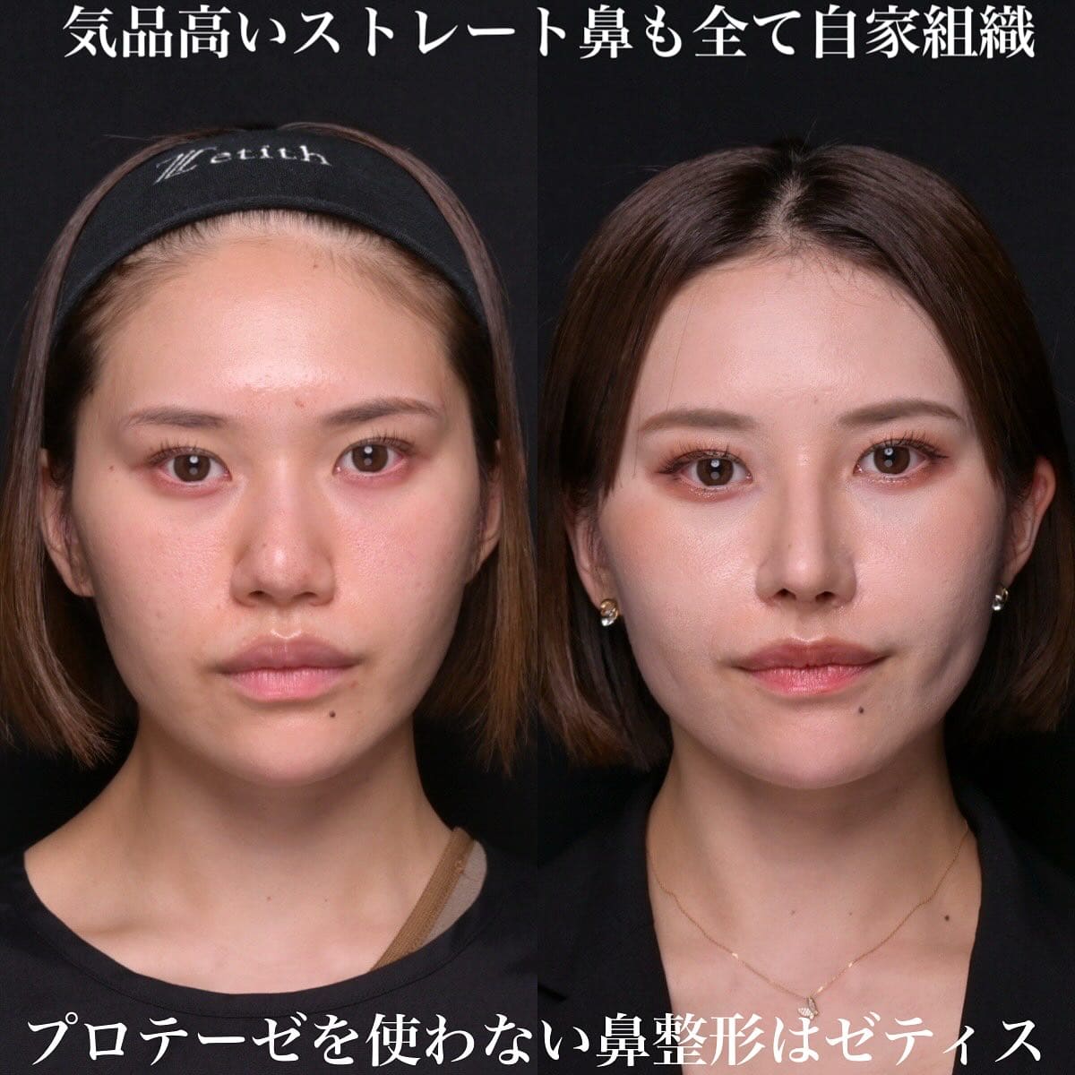 鉄医師による鼻整形の術前/術後1ヶ月