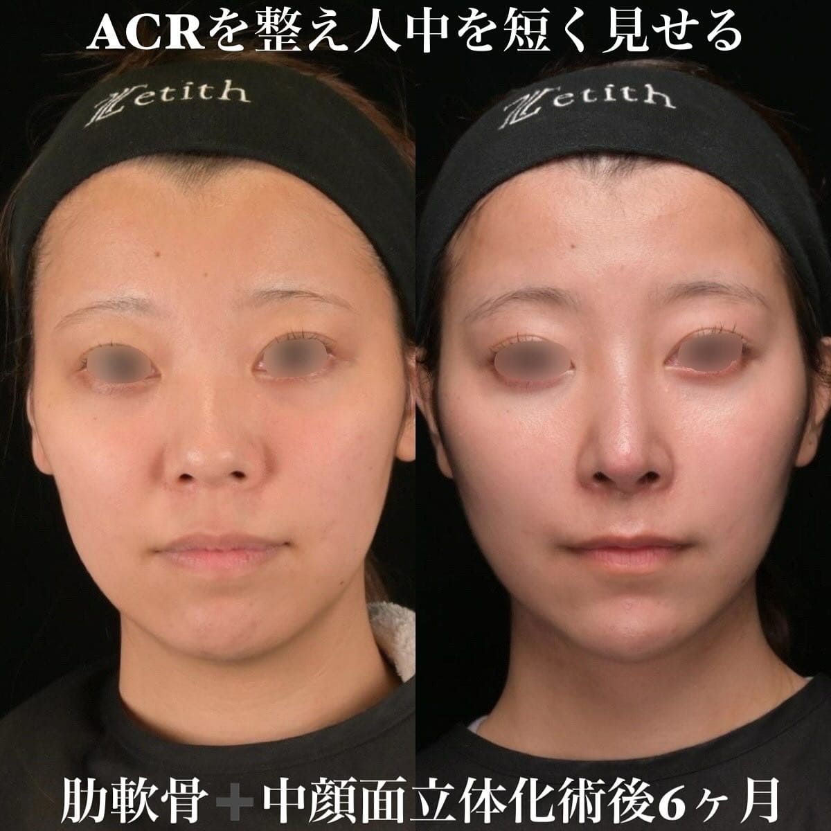 鉄医師による鼻整形の術前/術後6ヶ月