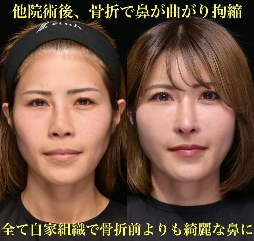 鉄医師による鼻整形の術前/術後３ヶ月
