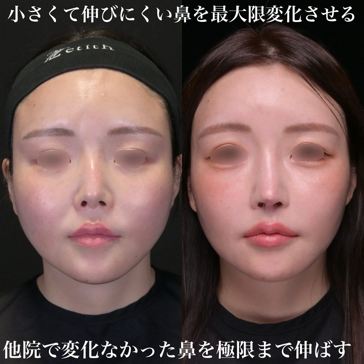 鉄医師による鼻整形の術前/術後1年