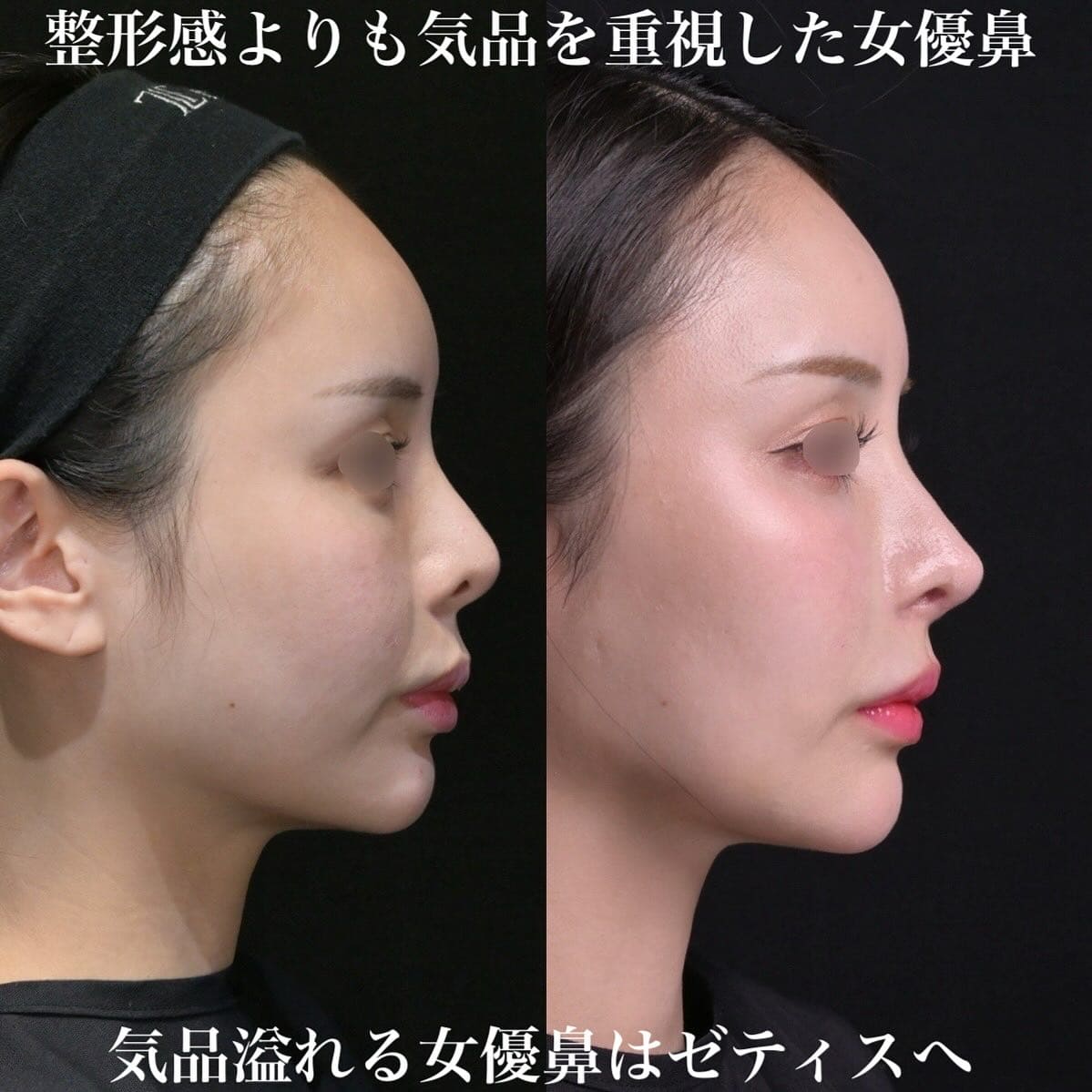 鉄医師による鼻整形の術前/術後6ヶ月 Sonra 