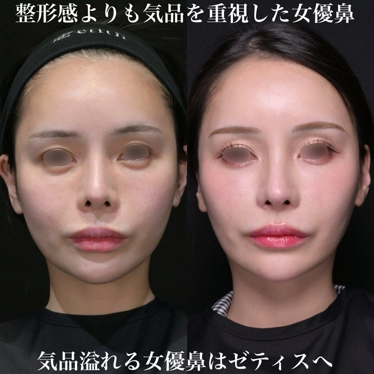 鉄医師による鼻整形の術前/術後6ヶ月