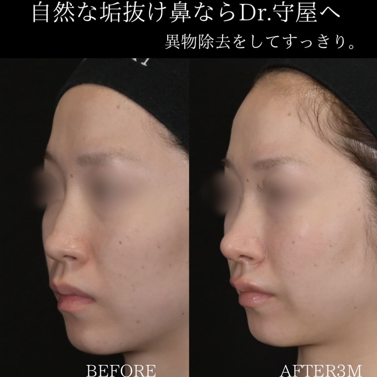 守屋医師による鼻整形の術前/術後３ヶ月