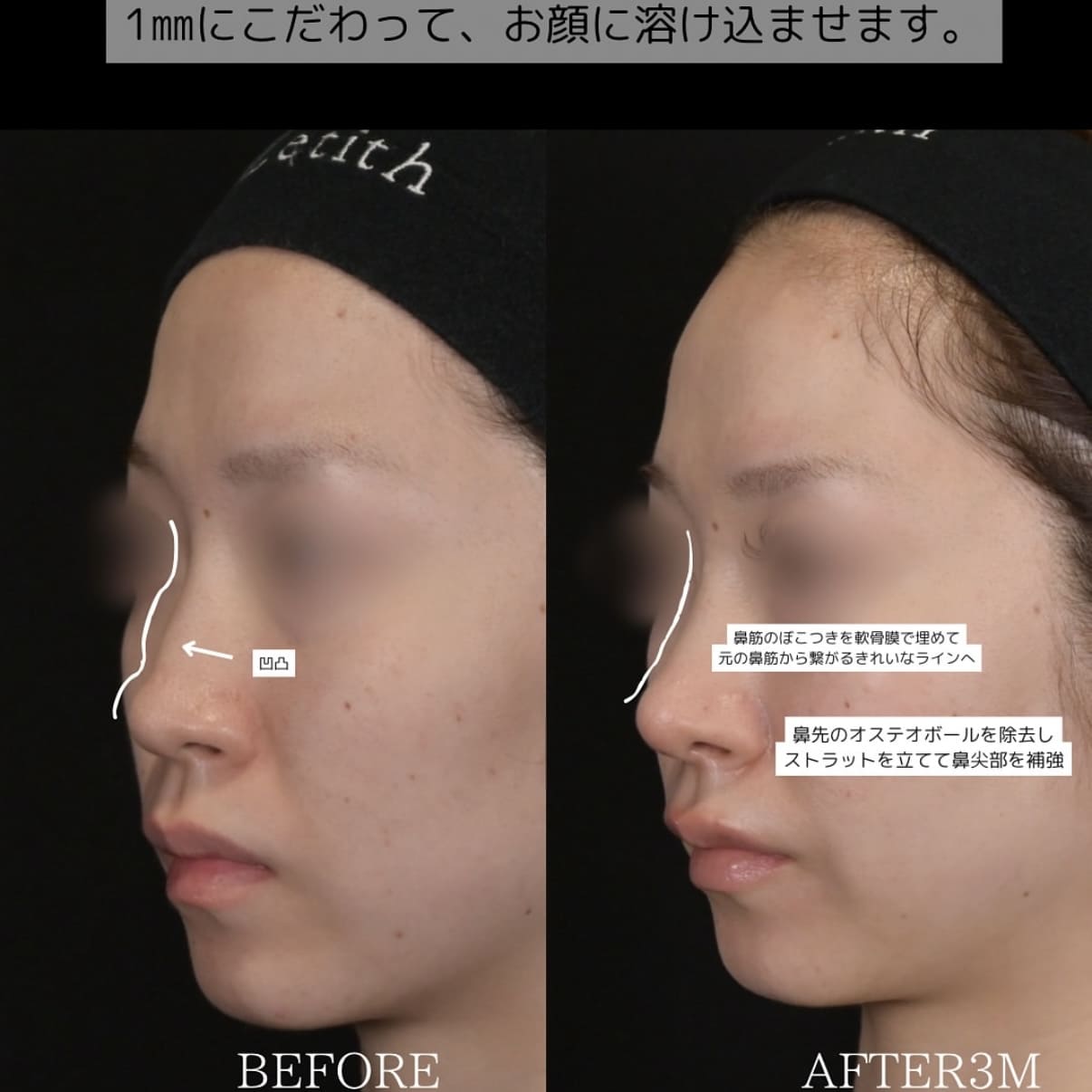 守屋医師による鼻整形の術前/術後３ヶ月 施術後 