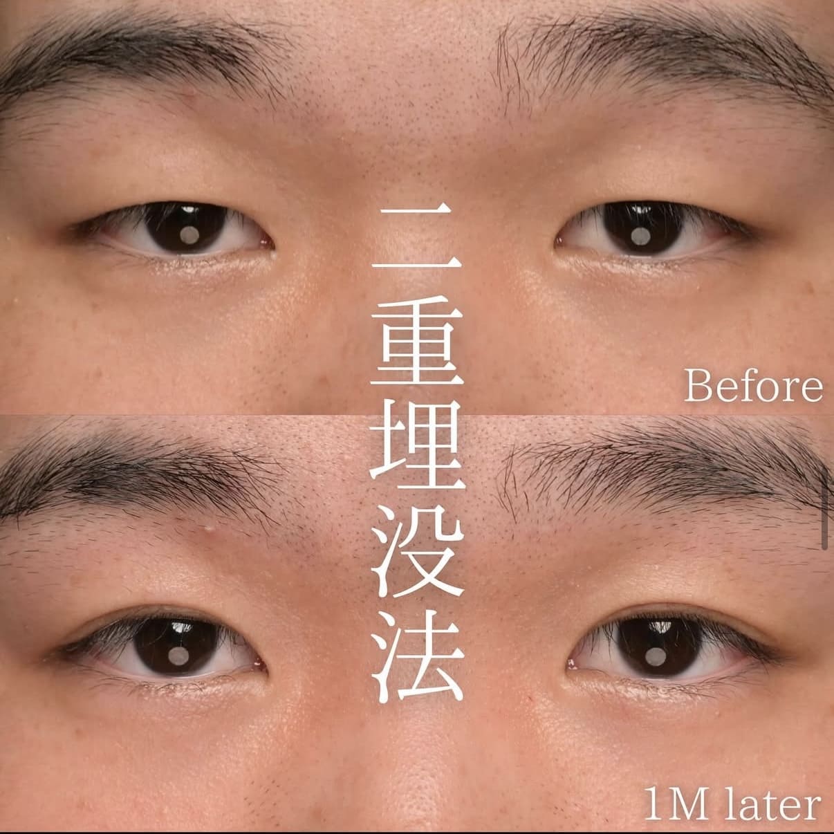 楠本医師による目元整形術前/術後