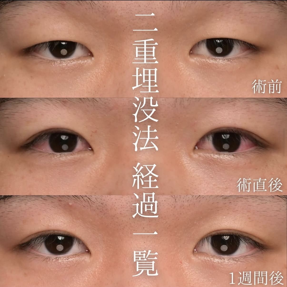 楠本医師による目元整形術前/術後 Sonra 