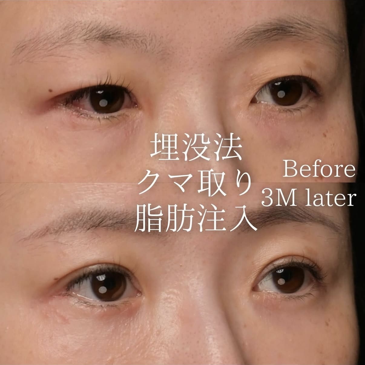 楠本医師による目元の複合形成術前/術後３ヶ月 بعد 