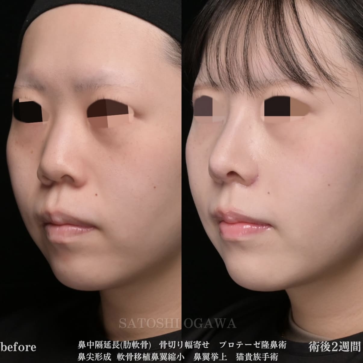 小川医師による鼻整形術前/術後２週間 Дараа 