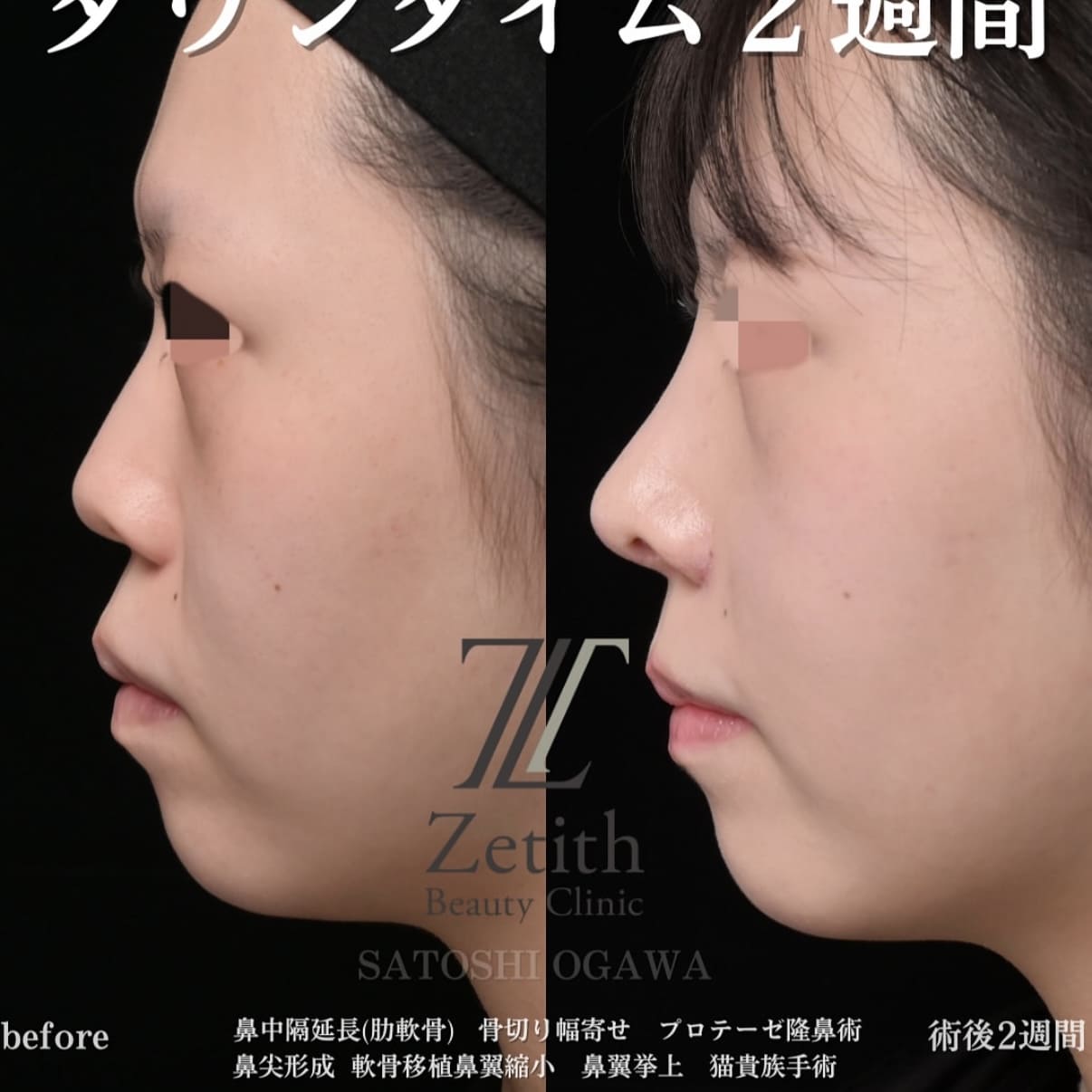 小川医師による鼻整形術前/術後２週間