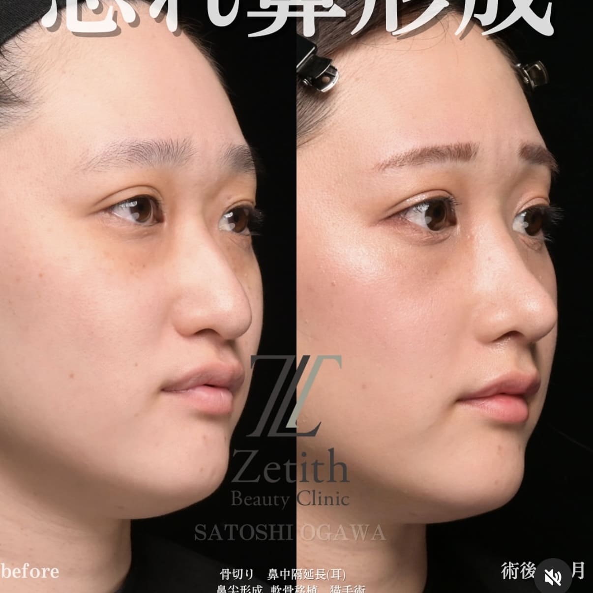 小川医師による鼻整形術前/術後1ヶ月