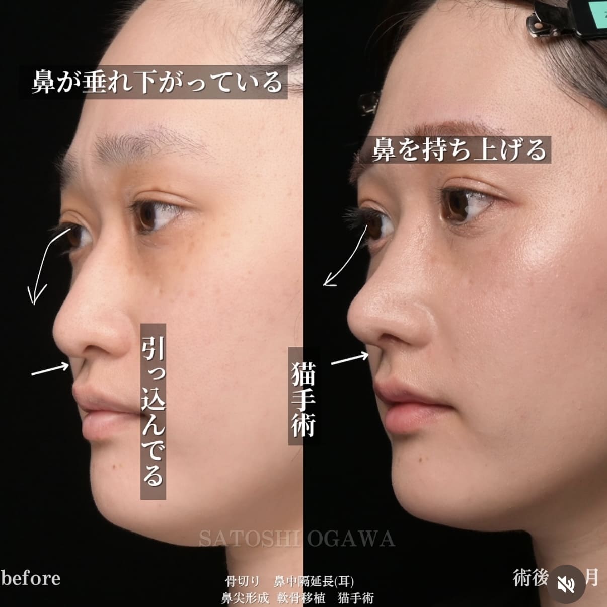 小川医師による鼻整形術前/術後1ヶ月 After 