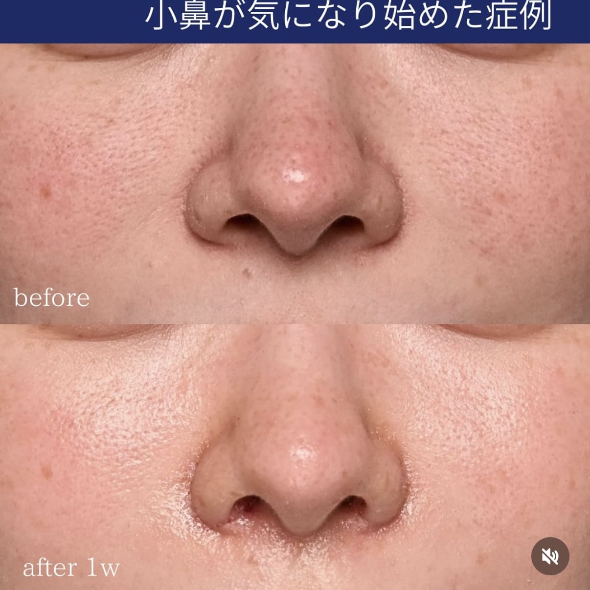 守屋医師による鼻整形術前/術後1週間
