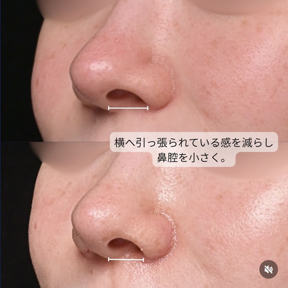 守屋医師による鼻整形術前/術後1週間 术后 