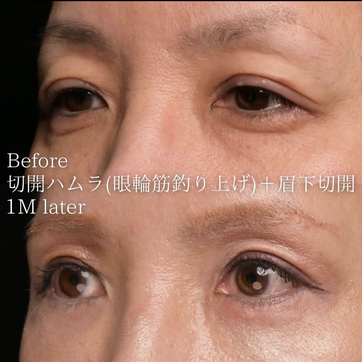 楠本医師による目元の複合施術術前/術後１ヶ月 Дараа 