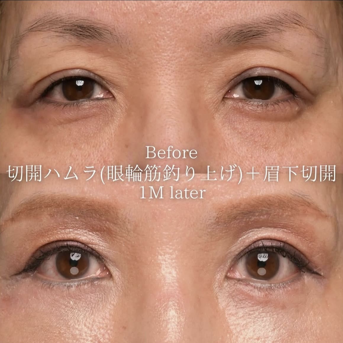 楠本医師による目元の複合施術術前/術後１ヶ月