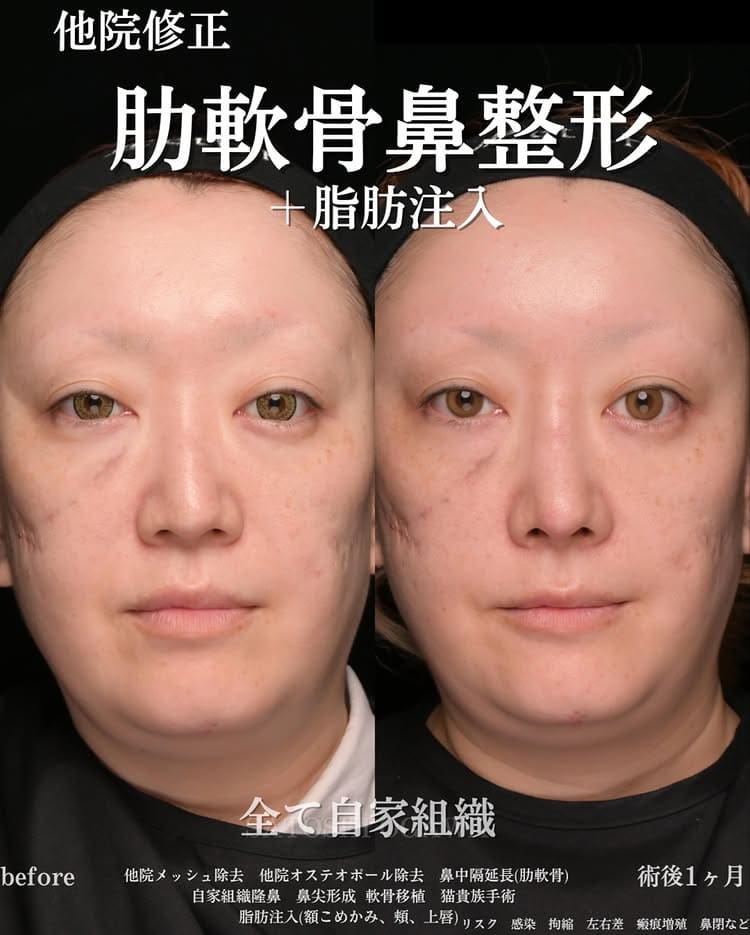 小川医師による鼻整形の術前/術後1ヶ月