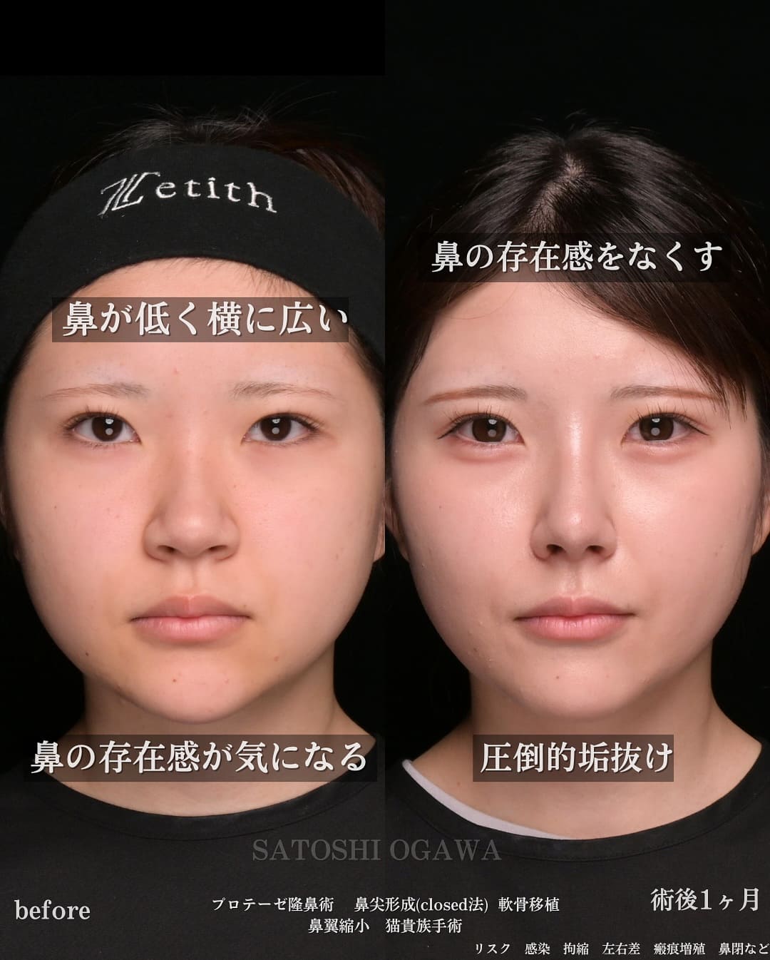 小川 医師による鼻整形の術前/術後1ヶ月