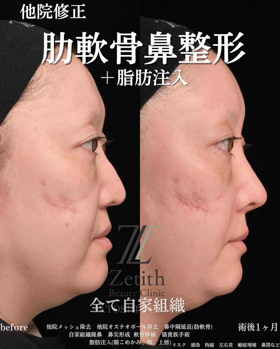 小川医師による鼻整形の術前/術後1ヶ月 术后 