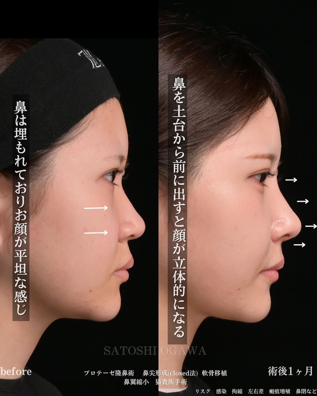 小川 医師による鼻整形の術前/術後1ヶ月 بعد 