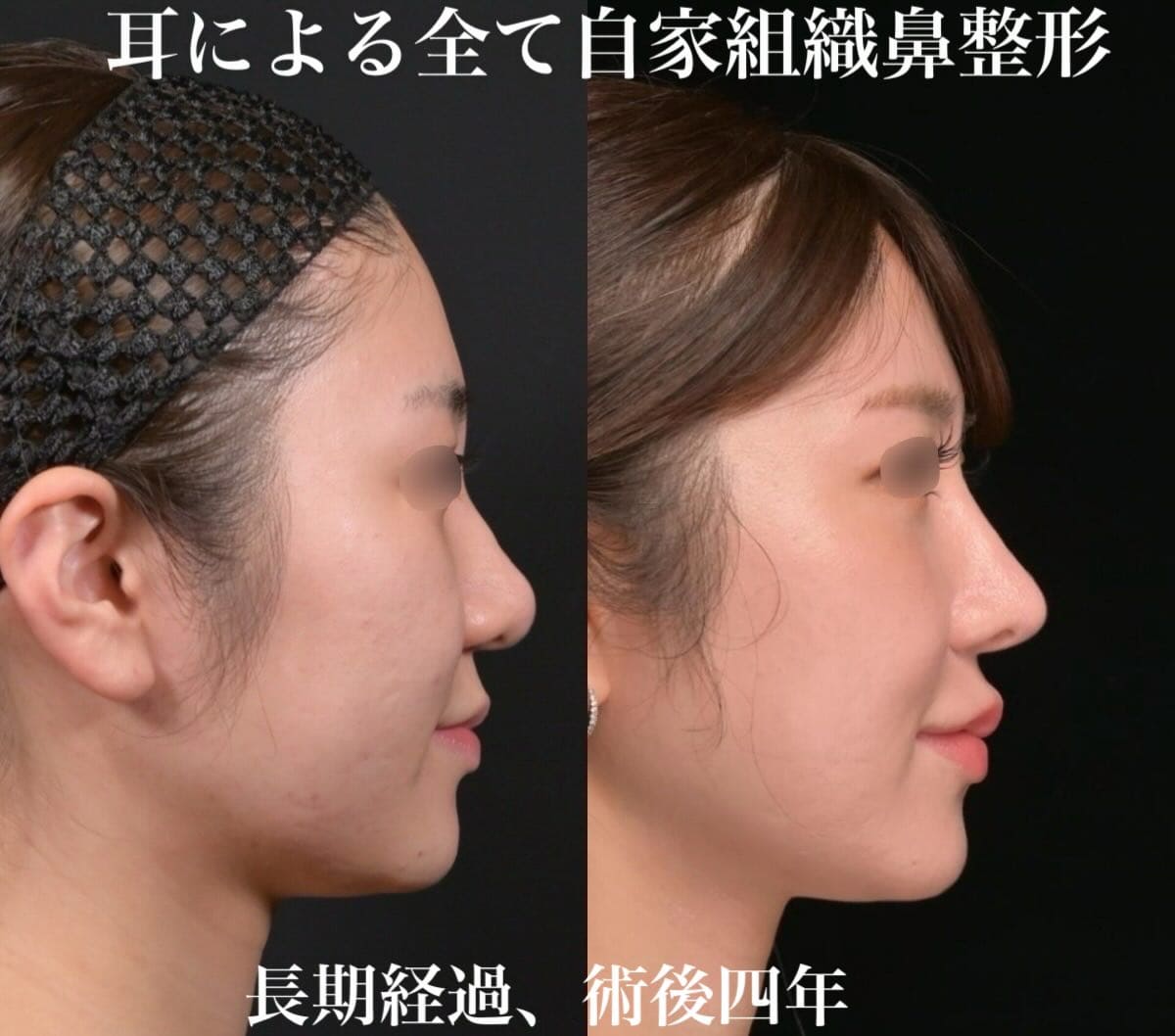 鉄医師による鼻整形の術前/術後4年 施術後 