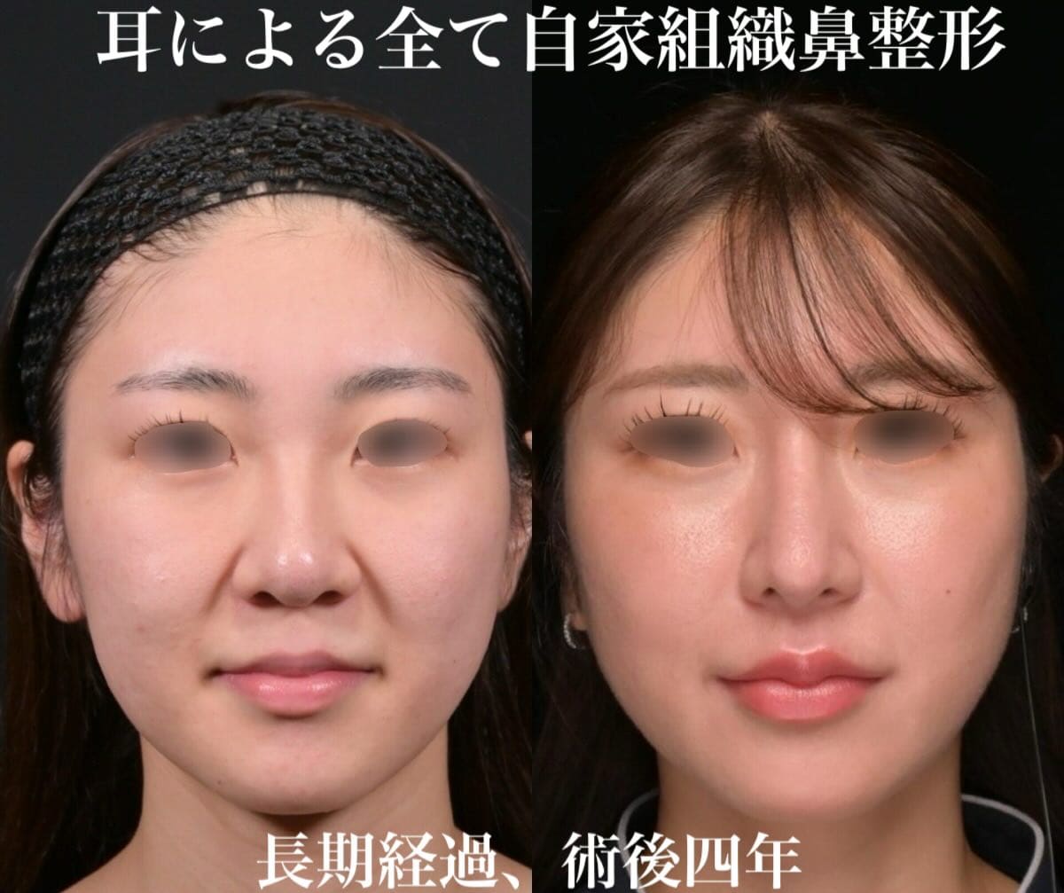 鉄医師による鼻整形の術前/術後4年